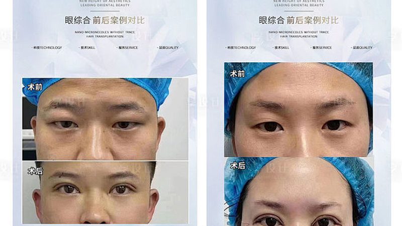 医美医院光电项目哪个好