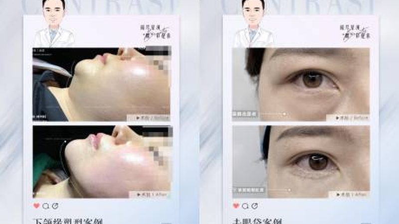 热玛吉恢复期揭秘：了解真实恢复过程