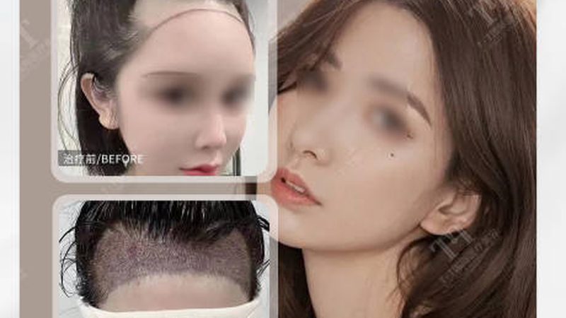 小标题：隆鼻手术，了解背后的技术原理