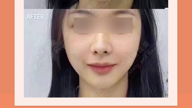 广州隆鼻术后恢复，这些细节你了解吗？**