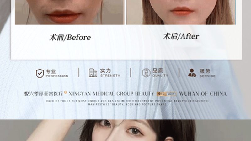 热玛吉效果能维持多久？揭秘其真实效果与维持时间