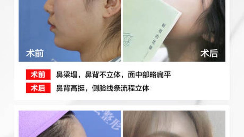 光子嫩肤家用机选购攻略：揭秘避坑技巧