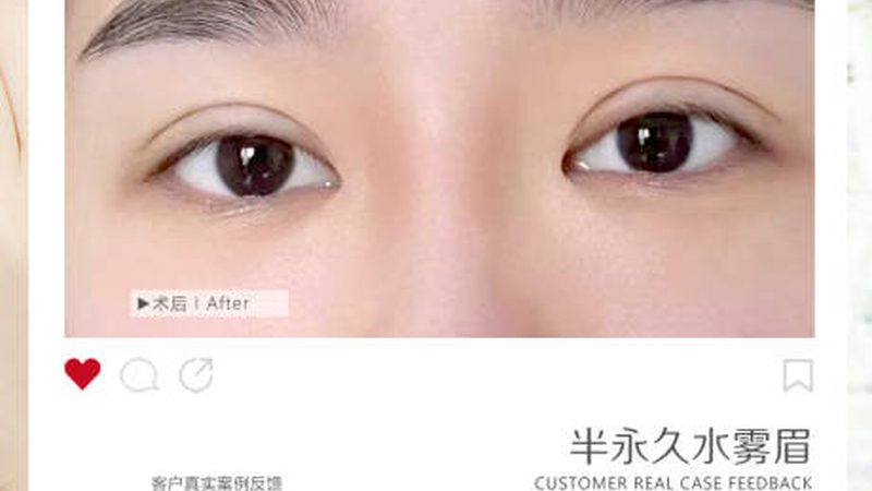 北京超声炮抗衰，揭秘正规医院的选择标准